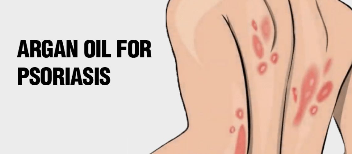 Argan Oil for Psoriasis